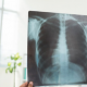 医疗保健提供者列出了9种简单有效的促进肺部健康的方法